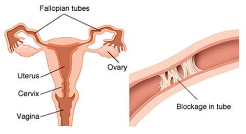 Causes for Infertility in Women